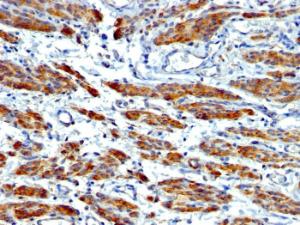 Immunohistochemical analysis of formalin-fixed, paraffin-embedded human leiomyosarcoma using Anti-MYH11 Antibody [MYH11/923 + SMMS-1]