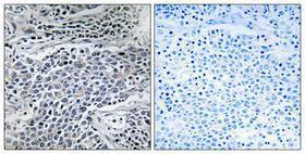 Immunohistochemical analysis of paraffin-embedded human lung cancer using Anti-MMP-11 Antibody 1:100 (4°C overnight). The right hand panel represents a negative control, where the antibody was pre-incubated with the immunising peptide