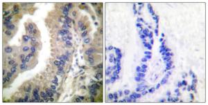 Immunohistochemical analysis of paraffin-embedded human lung carcinoma tissue using Anti-HSP90A Antibody. The right hand panel represents a negative control, where the antibody was pre-incubated with the immunising peptide.