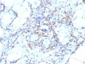 Immunohistochemical analysis of formalin-fixed, paraffin-embedded human angiosarcoma using Anti-MYH11 Antibody [MYH11/923 + SMMS-1]