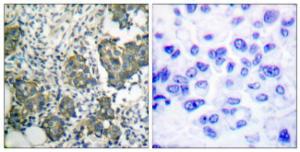 Immunohistochemical analysis of paraffin-embedded human breast carcinoma tissue using Anti-Keratin 8 Antibody. The right hand panel represents a negative control, where the antibody was pre-incubated with the immunising peptide