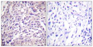 Immunohistochemical analysis of paraffin-embedded human breast carcinoma tissue using Anti-FOXO1A Antibody. The right hand panel represents a negative control, where the antibody was pre-incubated with the immunising peptide.