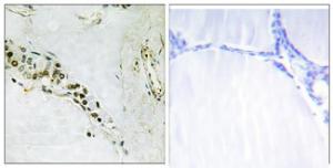 Immunohistochemical analysis of paraffin-embedded human thyroid gland tissue using Anti-Cyclin E2 Antibody. The right hand panel represents a negative control, where the antibody was pre-incubated with the immunising peptide