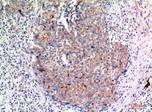 Immunohistochemical analysis of paraffin-embedded human breast cancer using Anti-MUC1 Antibody