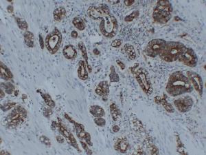 Immunohistochemical analysis of paraffin-embedded human Gastric adenocarcinoma using Anti-Cytokeratin 8 Antibody