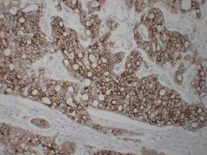 Immunohistochemical analysis of paraffin-embedded human Hepatocellular carcinoma using Anti-Cytokeratin 8 Antibody