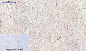 Immunohistochemical analysis of paraffin-embedded human uterus cancer tissue using Anti-mTOR Antibody at 1:200 (4°C overnight). Negative control was secondary antibody only