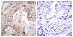 Immunohistochemical analysis of paraffin-embedded human lung carcinoma tissue using Anti-BCL-XL Antibody. The right hand panel represents a negative control, where the Antibody was pre-incubated with the immunising peptide