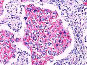 Immunohistochemical anaylsis of formalin-fixed, paraffin-embedded breast ductal carcinoma using Anti-beta Catenin Antibody. Note, membrane staining in ductal carcinoma.