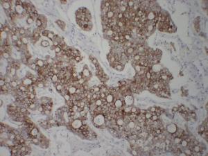 Immunohistochemical analysis of paraffin-embedded human Hepatocellular carcinoma using Anti-Cytokeratin 8 Antibody