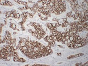 Immunohistochemical analysis of paraffin-embedded human Hepatocellular carcinoma using Anti-Cytokeratin 8 Antibody