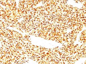 Immunohistochemical analysis of formalin-fixed, paraffin-embedded human rhabdomyosarcoma using Anti-MyoD1 Antibody [SPM427]