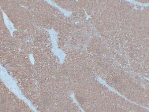 Immunohistochemical analysis of paraffin-embedded human Bladder transitional cell carcinoma using Anti-Cytokeratin 7 Antibody