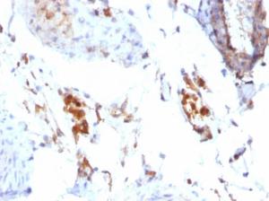 Immunohistochemical analysis of formalin-fixed, paraffin-embedded human testicular carcinoma using Anti-Ferritin Light Chain Antibody [FTL/1386]