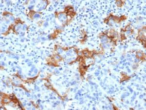 Immunohistochemical analysis of formalin-fixed, paraffin-embedded human liver carcinoma in colon tissue using Anti-TROP2 Antibody [TACSTD2/6394R]