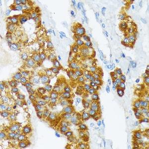 Immunohistochemistry analysis of paraffin-embedded human liver cancer using Anti-ATP1B3 Antibody [ARC2205] (A306065) at a dilution of 1:100 (40X lens). Perform microwave antigen retrieval with 10 mM Tris/EDTA buffer pH 9.0 before commencing with IHC staining protocol