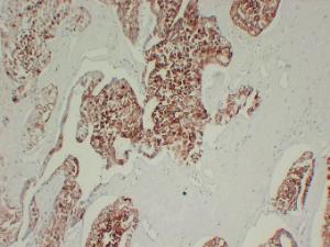 Immunohistochemical analysis of paraffin-embedded human Chromophobe cell renal carcinoma using Anti-Cytokeratin 7 Antibody