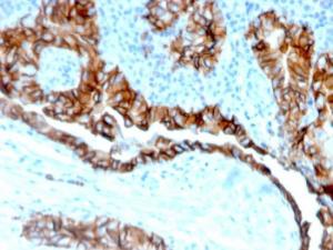 Immunohistochemical analysis of formalin-fixed, paraffin-embedded human thyroid carcinoma tissue using Anti-TROP2 Antibody [TACSTD2/6394R]