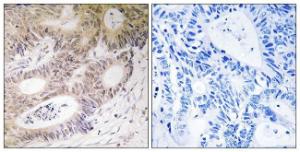 Immunohistochemical analysis of paraffin-embedded human colon carcinoma tissue using Anti-MSK1 Antibody. The right hand panel represents a negative control, where the antibody was pre-incubated with the immunising peptide.