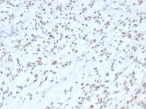 Immunohistochemical analysis of formalin-fixed, paraffin-embedded human rhabdomyosarcoma using Anti-MyoD1 Antibody [MYOD1/2075R]