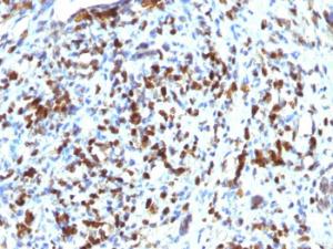 Immunohistochemical analysis of formalin-fixed, paraffin-embedded human rhabdomyosarcoma using Anti-MyoD1 Antibody [MYOD1/2075R]