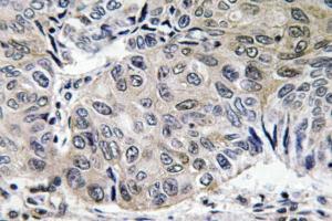 Immunohistochemical analysis of paraffin-embedded human lung carcinoma tissue using Anti-S-100A10 Antibody