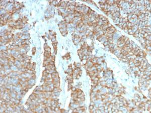 Immunohistochemical analysis of formalin-fixed, paraffin-embedded human neuroendocrine tumor using Anti-Drebrin Antibody [DBN1/3393]