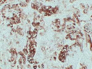 Immunohistochemical analysis of paraffin-embedded human Lung squamous cell carcinoma using Anti-Cytokeratin 6 Antibody