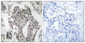 Immunohistochemical analysis of paraffin-embedded human breast carcinoma tissue using Anti-RAB3GAP2 Antibody. The right hand panel represents a negative control, where the Antibody was pre-incubated with the immunising peptide