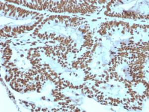 Immunohistochemical analysis of formalin-fixed, paraffin-embedded human breast carcinoma using Anti-ZNF846 Antibody [ZNF846/2687]