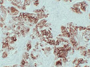 Immunohistochemical analysis of paraffin-embedded human Lung squamous cell carcinoma using Anti-Cytokeratin 6 Antibody