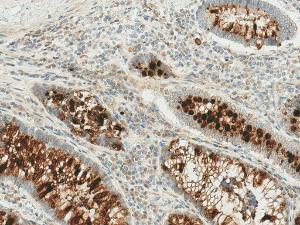 Immunohistochemistry analysis of human colon cancer, fixed in formalin and paraffin-embedded. The Primary Antibody used was Anti-RIP3 Antibody (A304917) at 1:50 for 30 minutes at room temperature. Counterstain: Hematoxylin. Magnification: 10X. HRP-DAB Detection.