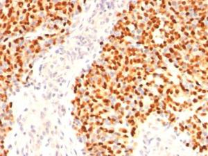 Immunohistochemical analysis of formalin-fixed, paraffin-embedded human rhabdomyosarcoma using Anti-Myogenin Antibody [F5D]