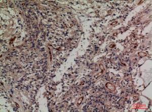 Immunohistochemical analysis of paraffin-embedded human ovary cancer using Anti-SNAP23 Antibody