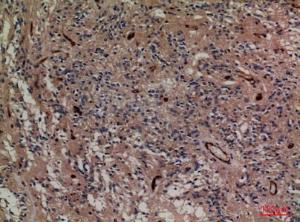 Immunohistochemical analysis of paraffin-embedded human ovary cancer using Anti-SNAP23 Antibody