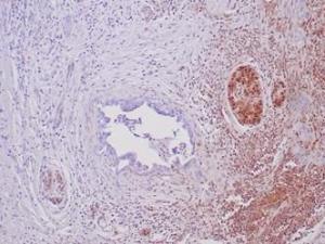 Immunohistochemical analysis, using Anti-SMAD4 Antibody [SMAD/6309R], showing loss of SMAD4 expression in pancreatic ductal adenocarcinoma. Note adjacent benign ductal epithelium and background stroma as internal control showing positive/retained SMAD4 staining