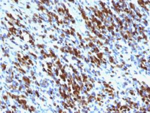 Immunohistochemical analysis of formalin-fixed, paraffin-embedded human rhabdomyosarcoma using Anti-Myogenin Antibody [MGN185 + F5D]