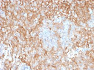 Immunohistochemical analysis of formalin-fixed, paraffin-embedded human lung tumor using Anti-HLA DR Antibody [TAL 1B5]