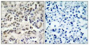 Immunohistochemical analysis of paraffin-embedded human lung carcinoma tissue using Anti-p27 Kip1 Antibody The right hand panel represents a negative control, where the antibody was pre-incubated with the immunising peptide