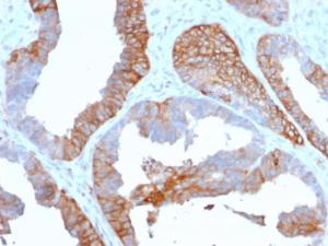 Immunohistochemical analysis of formalin-fixed, paraffin-embedded human prostate carcinoma using Anti-HLA DR Antibody [TAL 1B5]