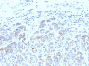 Immunohistochemical analysis of formalin-fixed, paraffin-embedded human melanoma using Anti-TRP1 Antibody [SPM611]