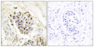 Immunohistochemical analysis of paraffin-embedded human breast carcinoma tissue using Anti-MED1 Antibody. The right hand panel represents a negative control, where the antibody was pre-incubated with the immunising peptide