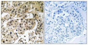 Immunohistochemical analysis of paraffin-embedded human breast carcinoma using Anti-HP1 alpha (phospho Ser92) Antibody. The right hand panel represents a negative control, where the antibody was pre-incubated with the immunising peptide.