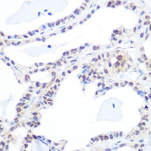 Immunohistochemistry analysis of paraffin-embedded human thyroid cancer using Anti-Topoisomerase I Antibody [ARC0708] (A307759) at a dilution of 1:100 (40X lens). Perform microwave antigen retrieval with 10 mM PBS buffer pH 7.2 before commencing with IHC staining protocol