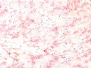 Immunohistochemical analysis of formalin-fixed, paraffin-embedded human melanoma using Anti-TRP1 Antibody [TYRP1/1564R]