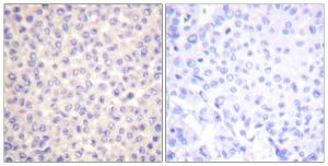 Immunohistochemical analysis of paraffin-embedded human breast carcinoma using Anti-FADD (phospho Ser194) Antibody The right hand panel represents a negative control, where the antibody was pre-incubated with the immunising peptide