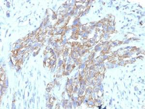 Immunohistochemical analysis of formalin-fixed, paraffin-embedded human lung carcinoma using Anti-NCAM1 Antibody [123C3.D5 + 123A8]