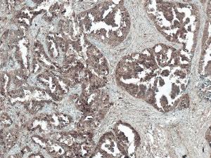 Immunohistochemistry analysis of human lung cancer, fixed in formalin and paraffin-embedded. The Primary Antibody used was Anti-Tuberin Antibody (A304921) at 1:50 for 30  minutes at room temperature. Counterstain: Hematoxylin. Magnification: 10X. HRP-DAB Detection