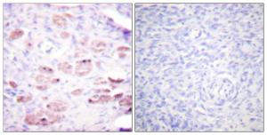 Immunohistochemical analysis of paraffin-embedded human ovary using Anti-Daxx (phospho Ser668) Antibody. The right hand panel represents a negative control, where the antibody was pre-incubated with the immunising peptide