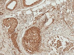 Immunohistochemistry analysis of human breast cancer, fixed in formalin and paraffin-embedded. The Primary Antibody used was Anti-Bad Antibody (A304922) at 1:50 for 30 minutes at room temperature. Counterstain: Hematoxylin. Magnification: 10X. HRP-DAB Detection